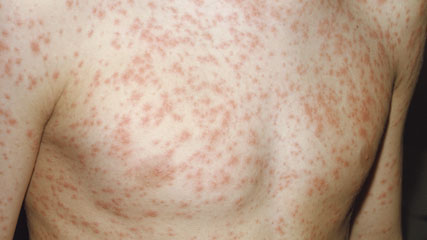 picture-rubella-german-measles-lucan-pharmacy.jpg